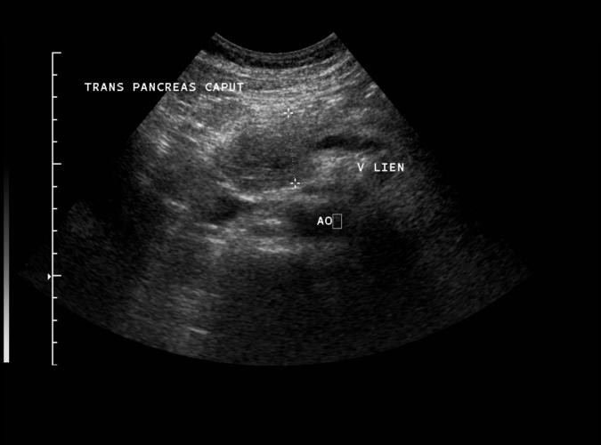 6a av  Catherine Olsson, sonograf